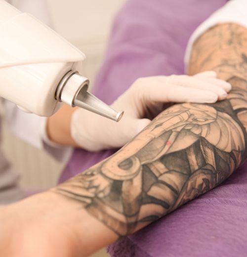 Eliminación de Manchas y Tatuajes en Fuengirola